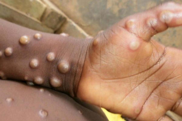 Varíola do Macaco: Os sintomas e como se proteger contra o vírus