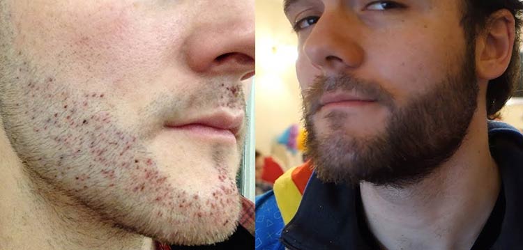 implante-de-barba