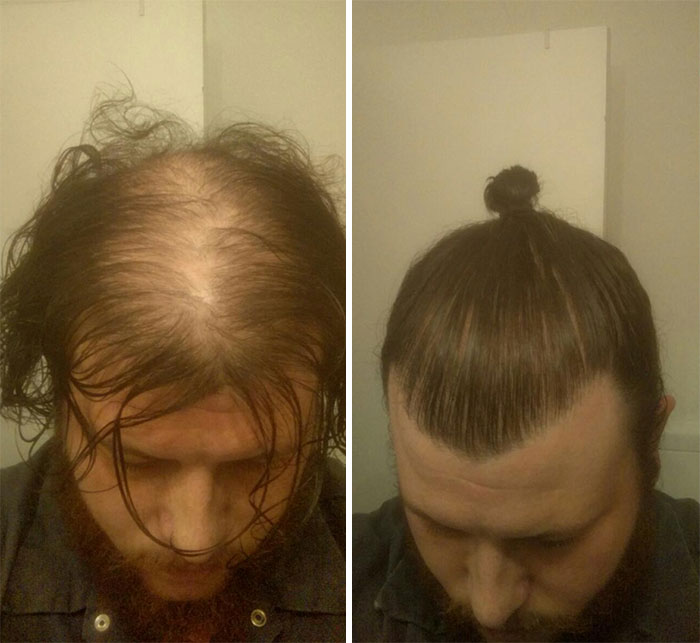 man-bun-hide-baldness-1-59199d988a20b__700