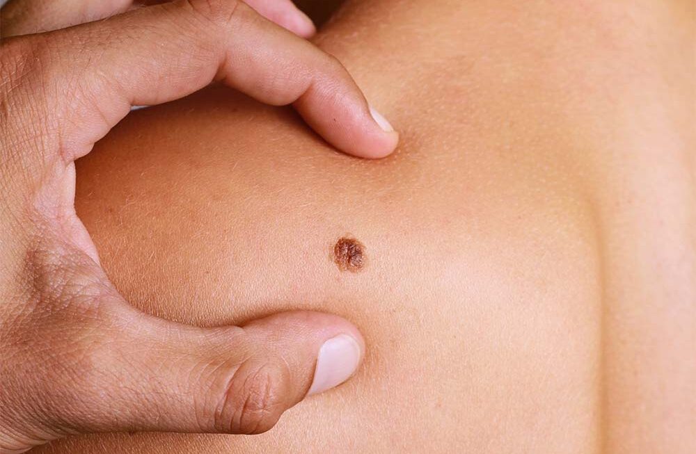 Melanoma: O câncer de pele mais agressivo