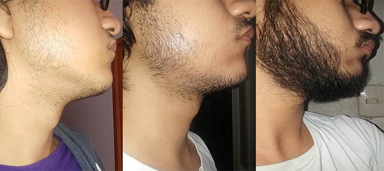 Minoxidil: O Que É e Como Usar Para Fazer Sua Barba Crescer